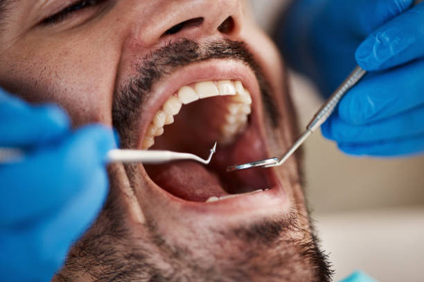 Best Emergency Dentist for Lost Fillings or Crowns in Gordonsville, VA