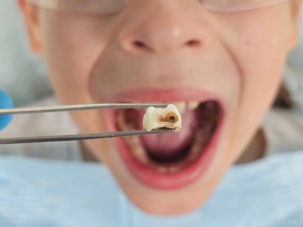 Best Emergency Dental Extractions in Gordonsville, VA